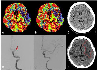 Lupus Antibody Mimicking Reduced Plasmatic Coagulation in a Patient With Atrial Fibrillation and Ischemic Stroke